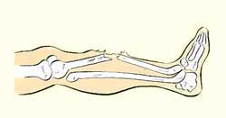 Fracture diagram